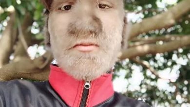 s&iacute;ndrome del hombre lobo