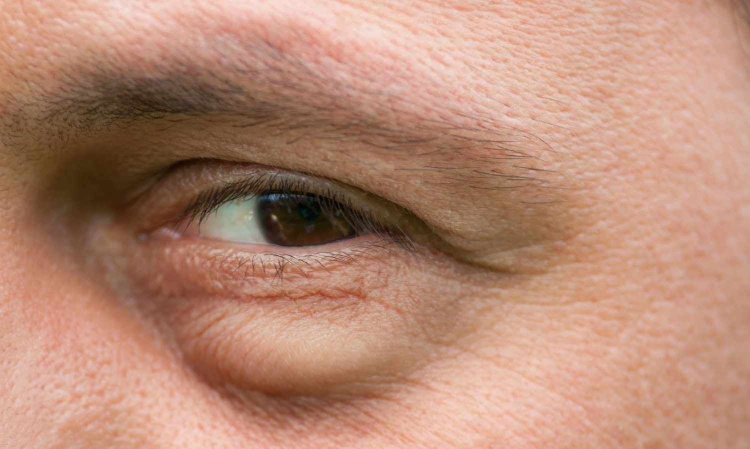 bolsas bajo los ojos