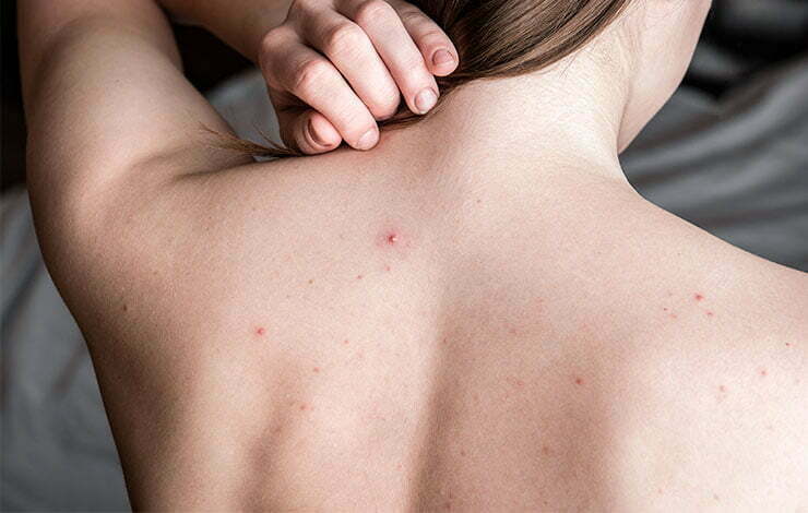 Granos en la espalda