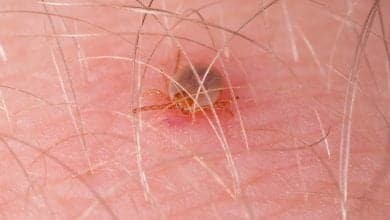 Un hombre perdi&oacute; la vida por la picadura de una garrapata