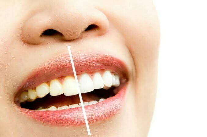 manchas amarillas en los dientes / dientes