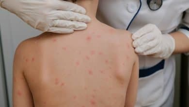 Qu&eacute; es la viruela del mono y cu&aacute;les son sus s&iacute;ntomas / viruela del mono en ni&ntilde;os / Gripe de tomate / viruela del mono en una ni&ntilde;a en Bolivia