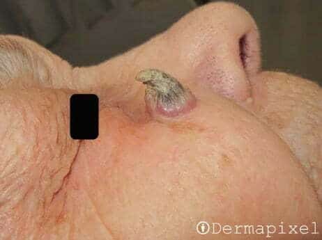 c&aacute;ncer de piel