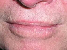 c&aacute;ncer de piel