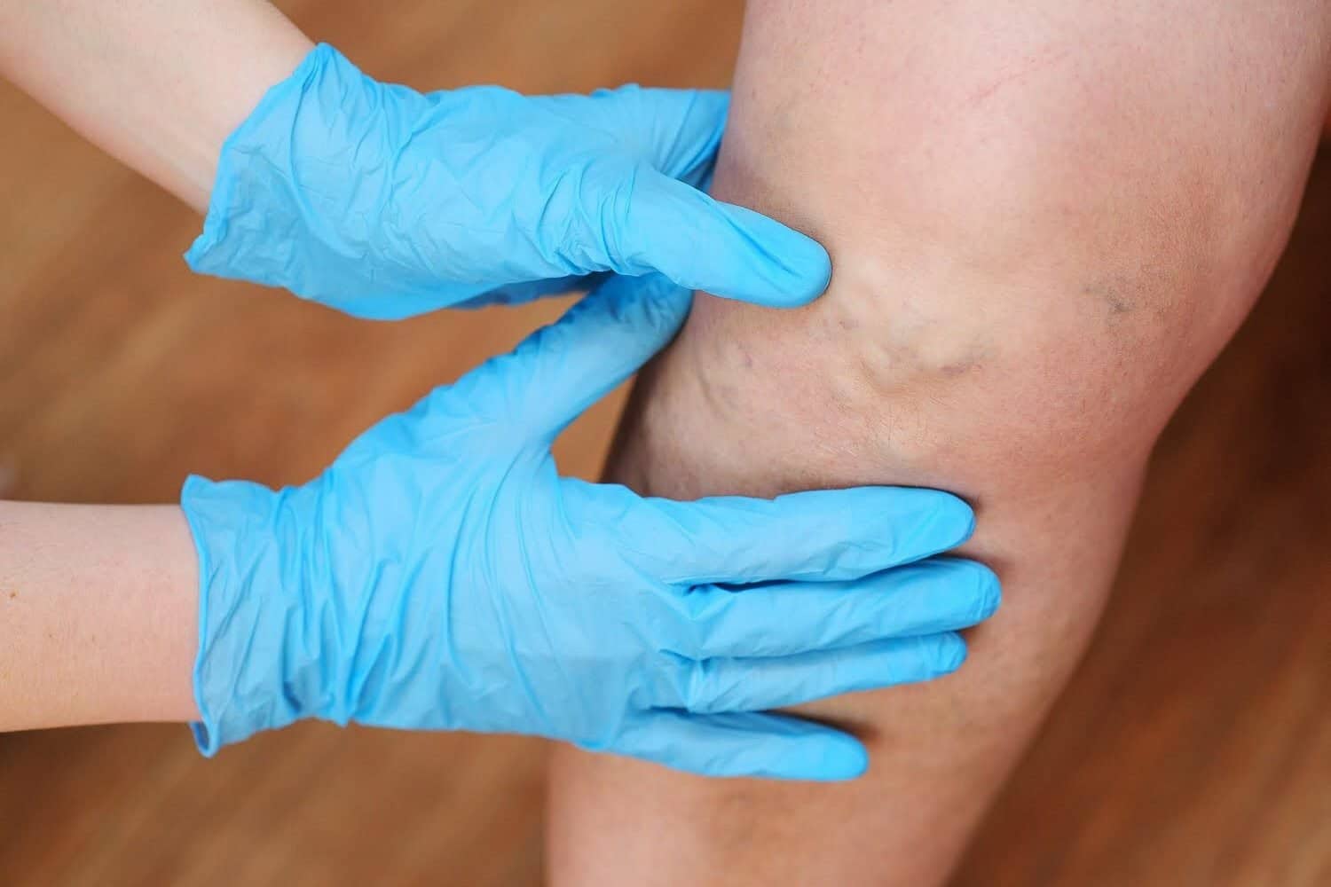 Trombosis venosa profunda