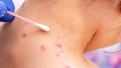 viruela del mono en m&eacute;xico