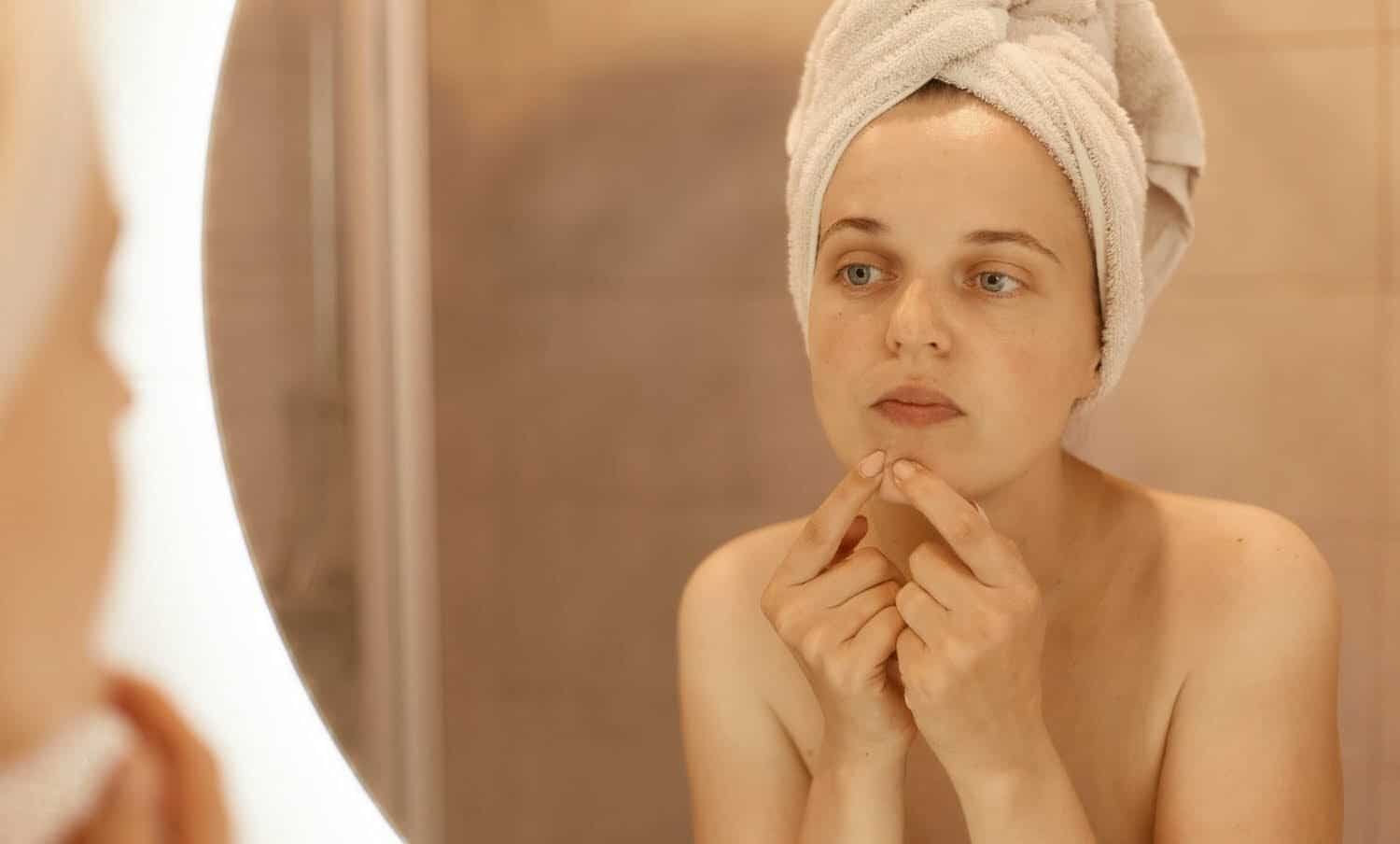 5 remedios naturales ideales contra el acn&eacute; menstruaci&oacute;n / Enfermedades que afectan el rostro