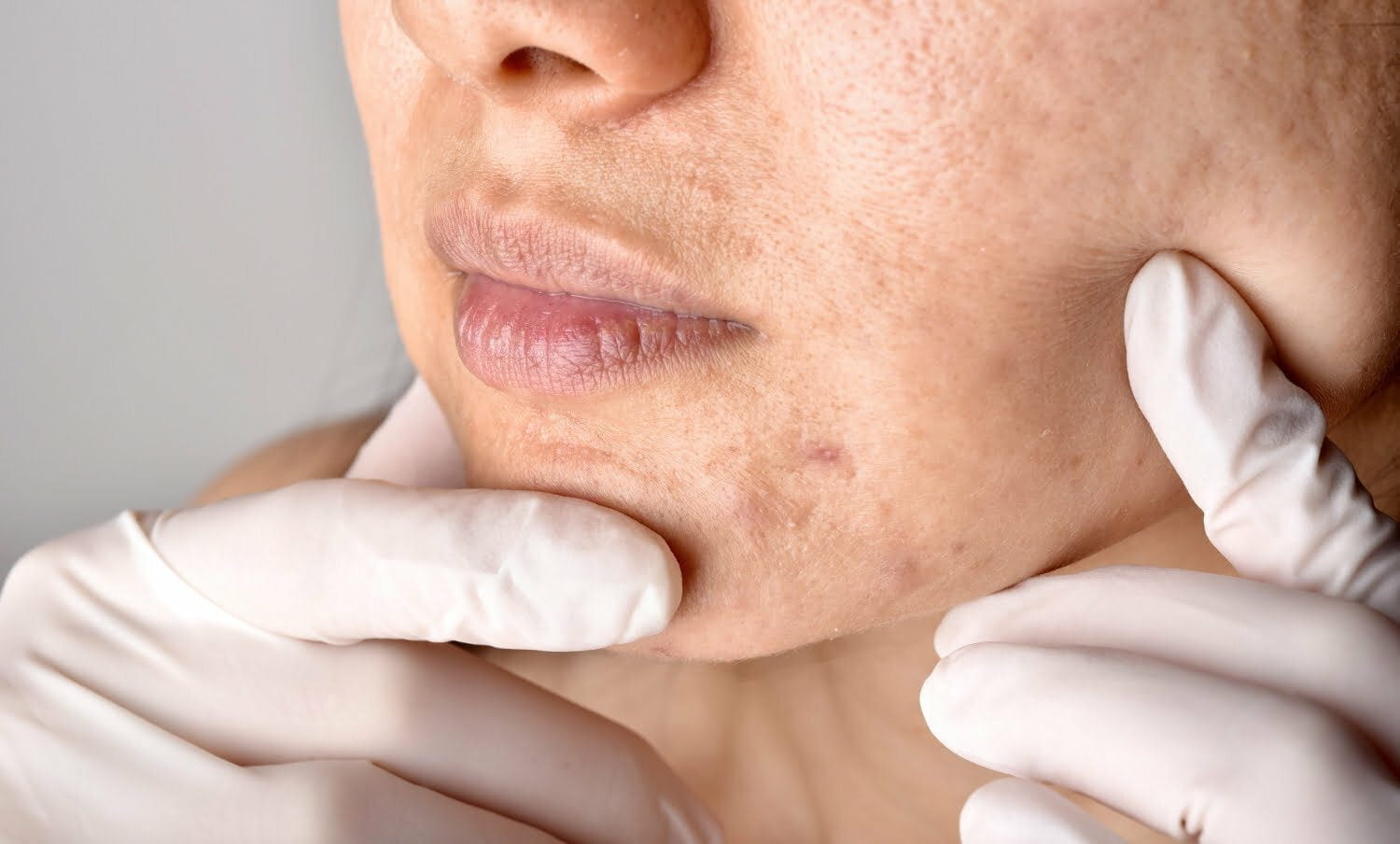 tratamientos naturales para los poros abiertos y dilatados en el rostro 