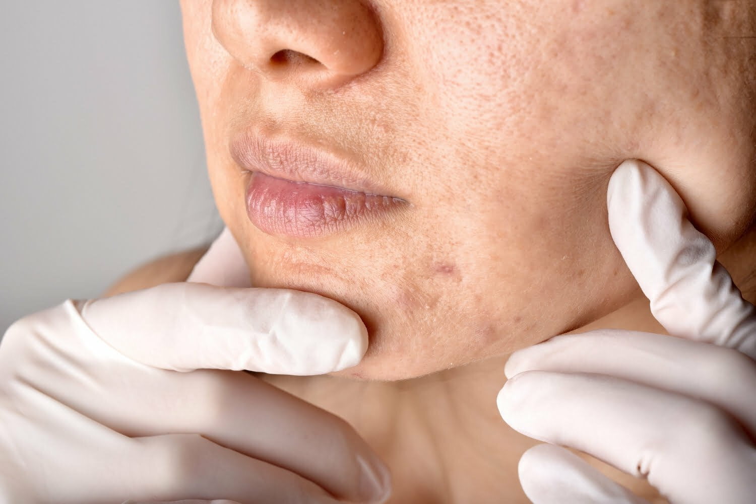 tratamientos naturales para los poros abiertos y dilatados en el rostro 