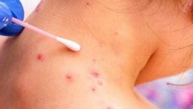 viruela del mono en costa rica