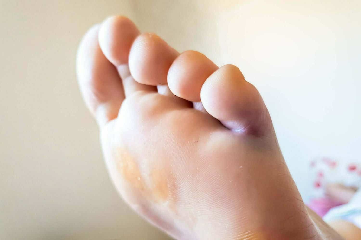 &iquest;C&oacute;mo saber si se fractur&oacute; el dedo del pie y cu&aacute;l es el tratamiento?