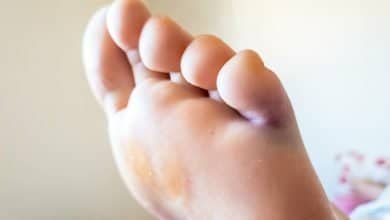 &iquest;C&oacute;mo saber si se fractur&oacute; el dedo del pie y cu&aacute;l es el tratamiento?