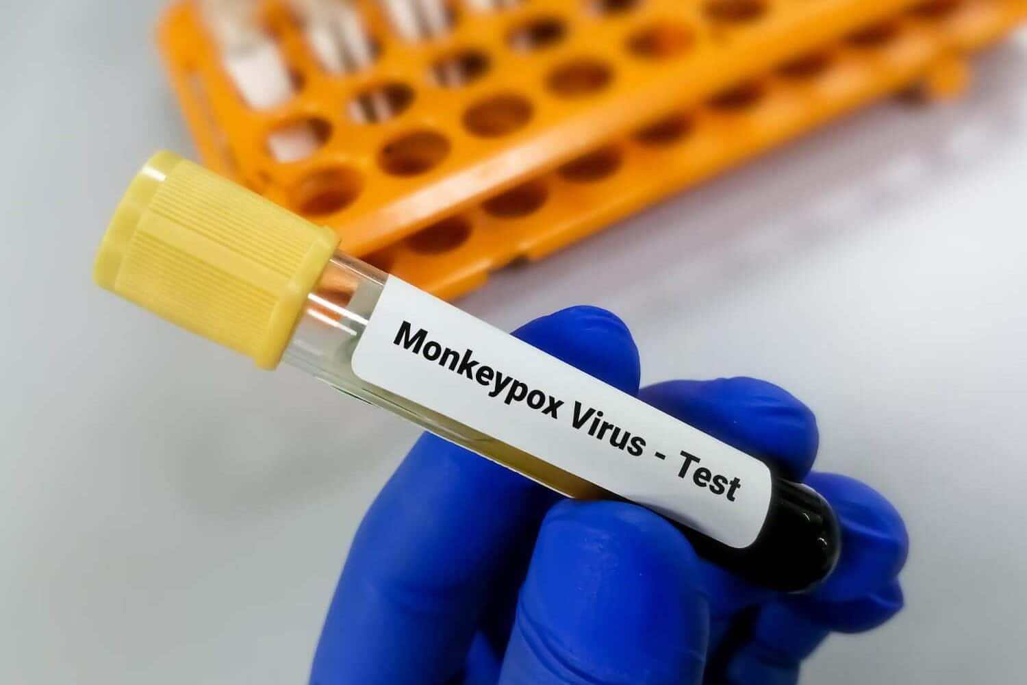 viruela del mono / viruela del mono en Espa&ntilde;a / viruela del mono en colombia / viruela del mono en Barranquilla / muerte por viruela del mono en B&eacute;lgica / viruela del mono en Cesar