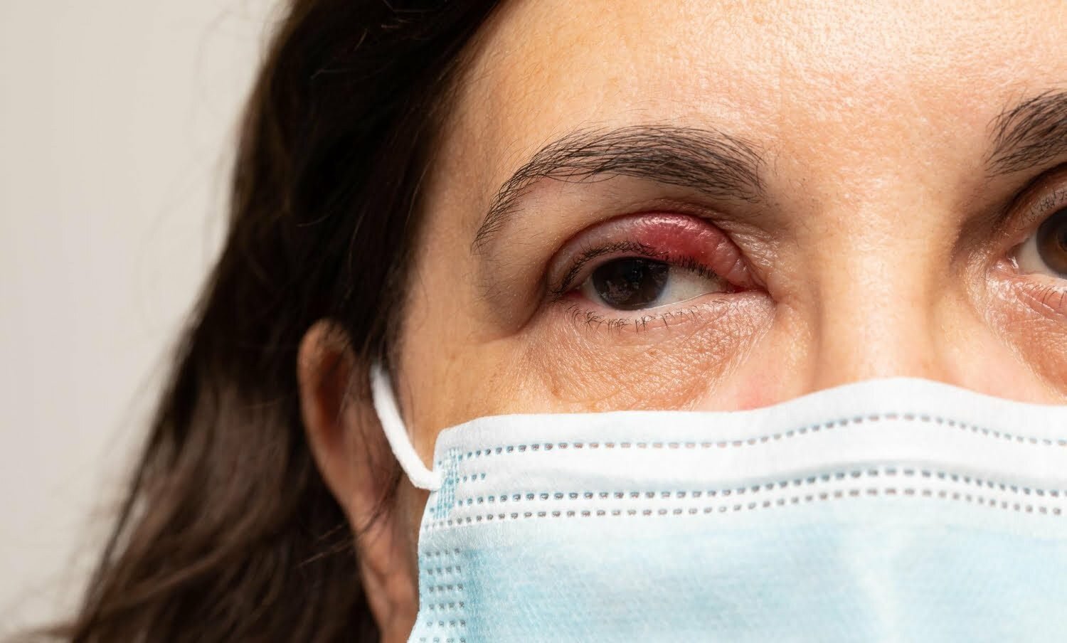 c&oacute;mo tratar los orzuelos