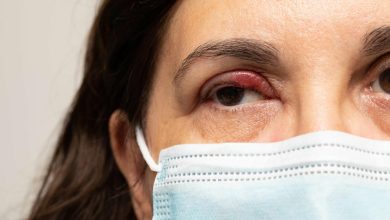 c&oacute;mo tratar los orzuelos