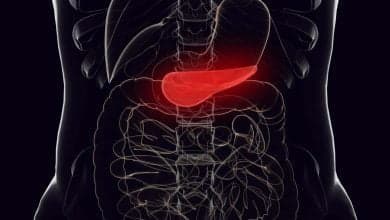 relaci&oacute;n entre el c&aacute;ncer de p&aacute;ncreas y el consumo de az&uacute;car