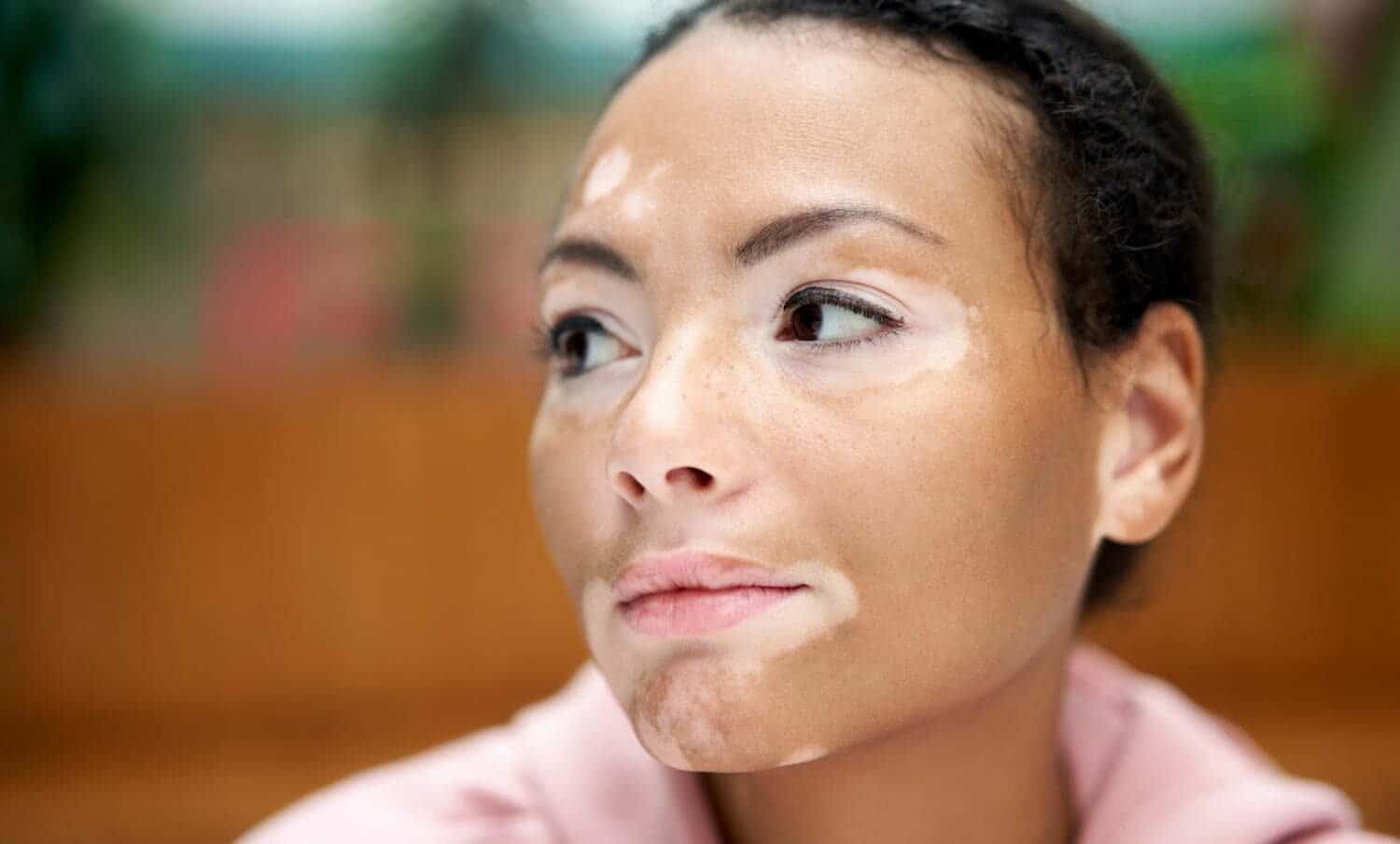 vitiligo