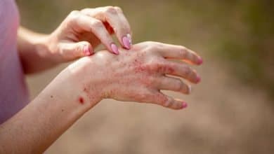 dermatitis at&oacute;pica