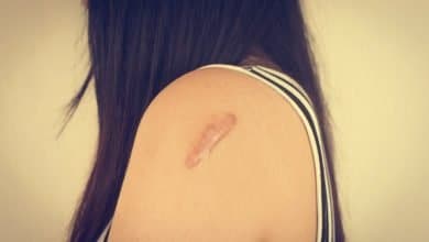 Mujer con una cicatriz en el brazo / cicatrices