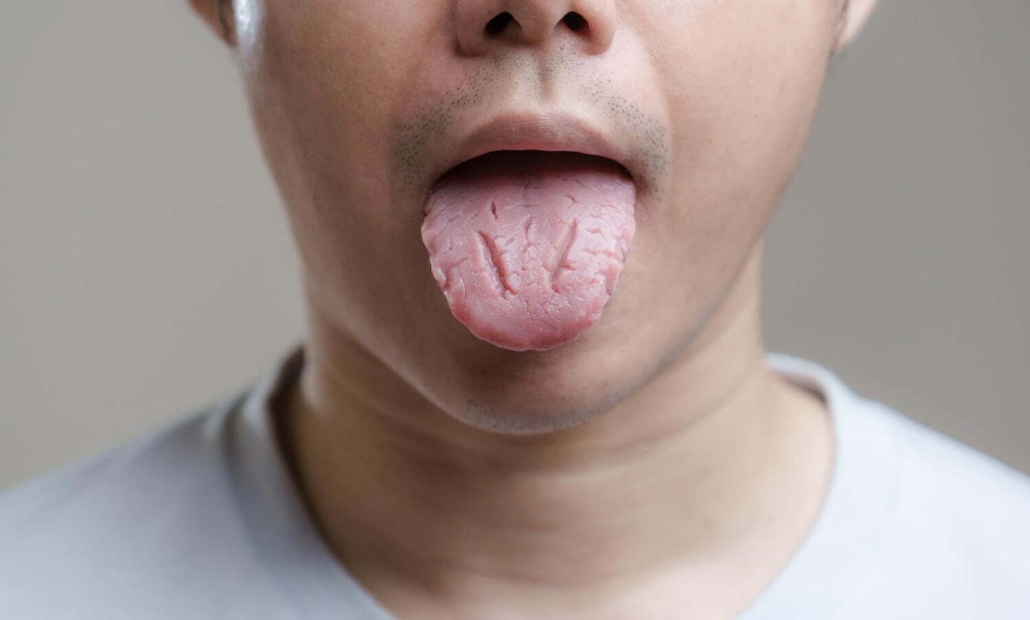 fisuras en la lengua
