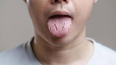 fisuras en la lengua