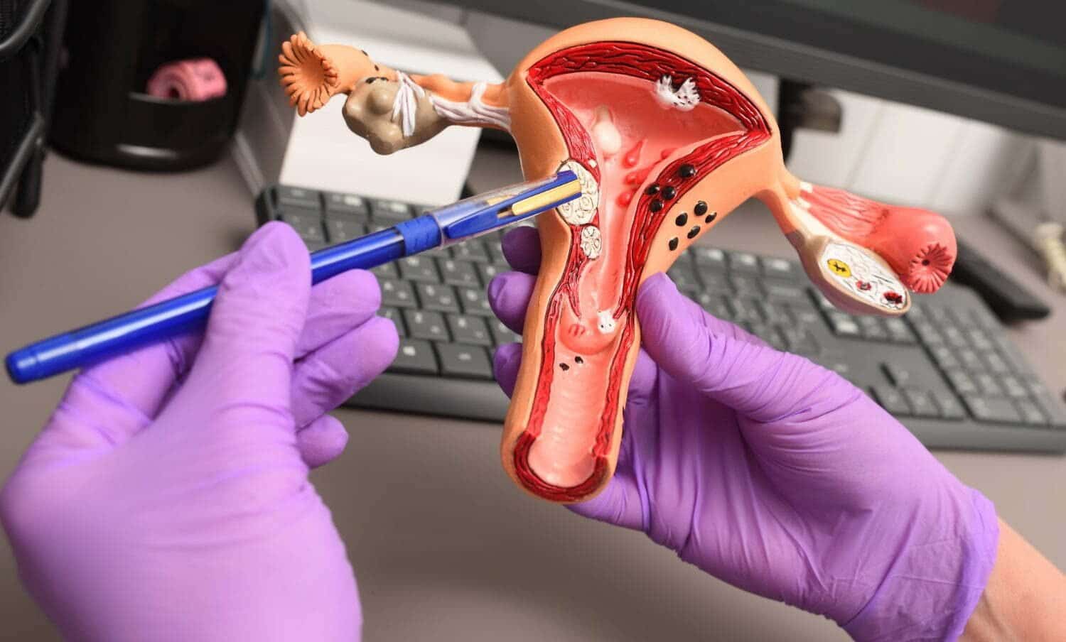 Modelo de &uacute;tero humano en manos de un ginec&oacute;logo para se&ntilde;alar la endometriosis