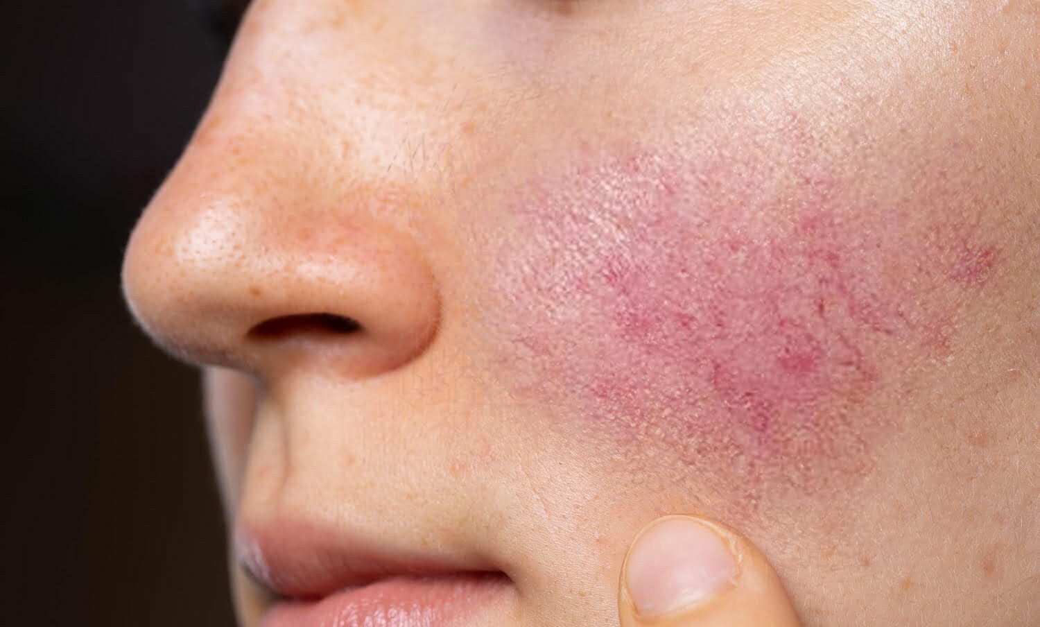 Mujer cauc&aacute;sica con zona roja en su rostro, a causa de ros&aacute;cea / s&aacute;bila