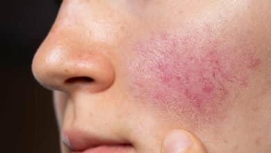 Mujer cauc&aacute;sica con zona roja en su rostro, a causa de ros&aacute;cea / s&aacute;bila
