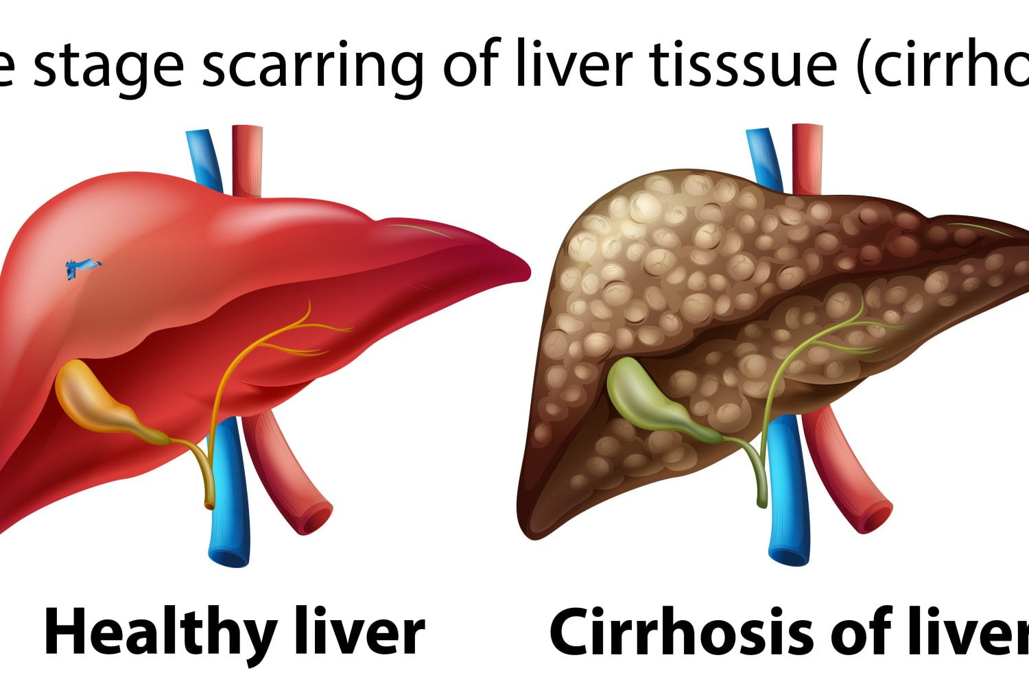 Ilustración de un hígado sano y un hígado con cirrosis
