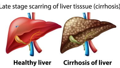 Ilustración de un hígado sano y un hígado con cirrosis