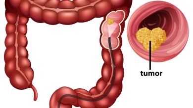 Infograf&iacute;a sobre el c&aacute;ncer colorrectal