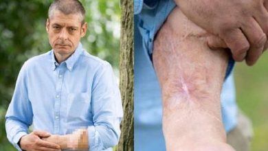 por qu&eacute; este hombre pas&oacute; 6 a&ntilde;os con un miembro injertado en el brazo