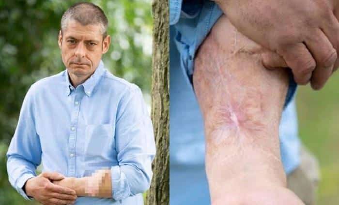 por qu&eacute; este hombre pas&oacute; 6 a&ntilde;os con un miembro injertado en el brazo