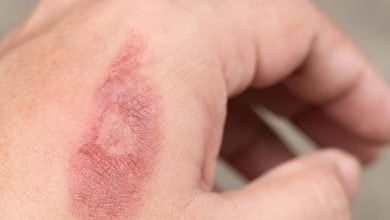 quemadura en la piel de la mano de una persona