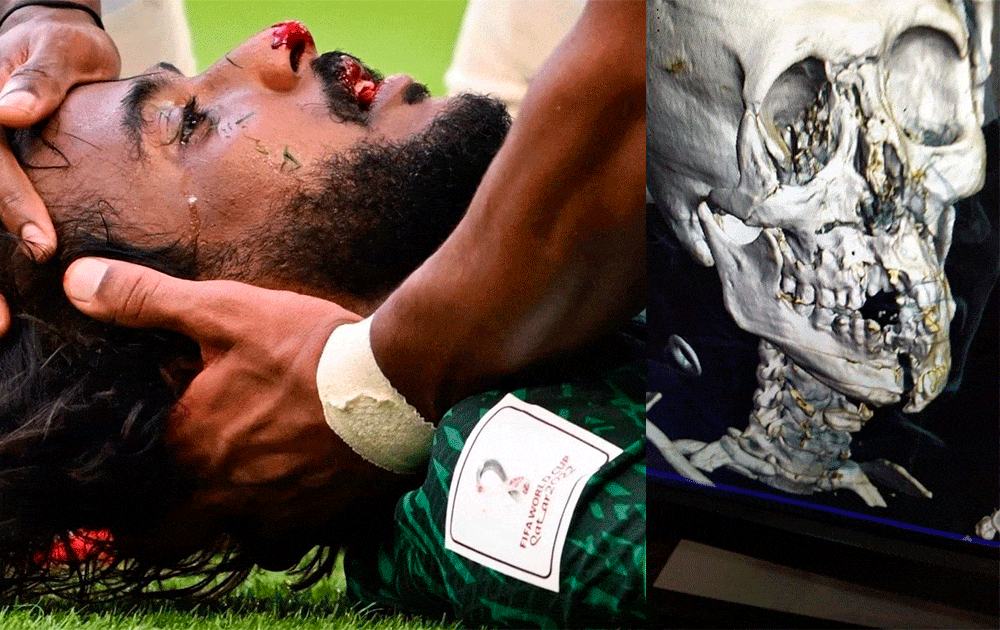 Revelaron radiografías de la impresionante fractura del jugador de Arabia en partido con Argentina