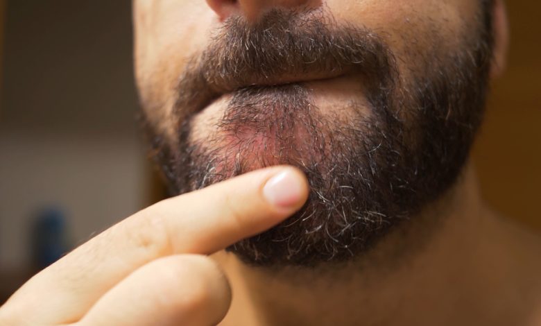 Foliculitis de la barba: as&iacute; se puede prevenir