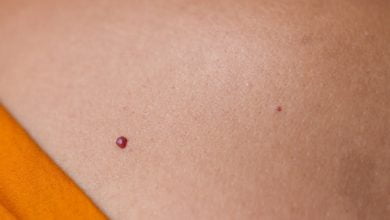 Por qu&eacute; salen puntos rojos en la piel y c&oacute;mo eliminarlos