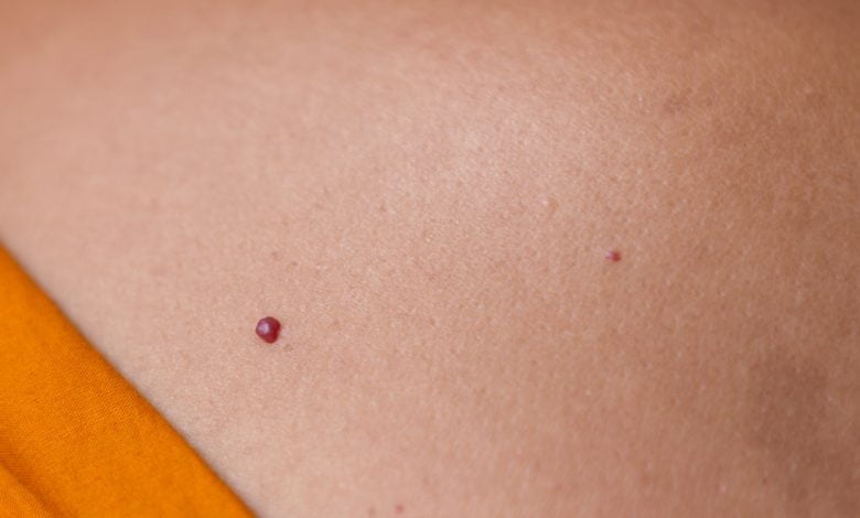 Por qu&eacute; salen puntos rojos en la piel y c&oacute;mo eliminarlos