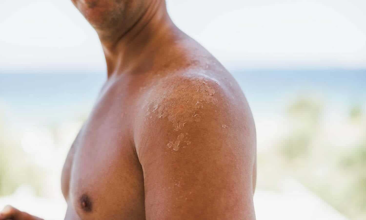 Hombre que se le descama la piel del hombro
