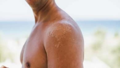 Hombre que se le descama la piel del hombro