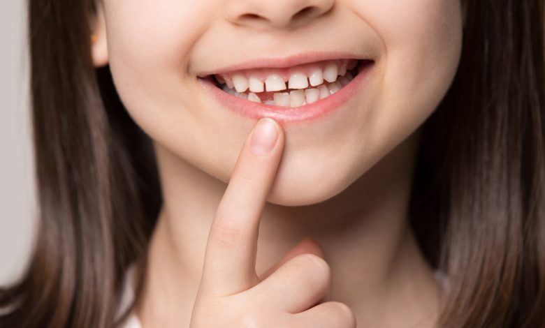 niña sonriendo ampliamente, mostrando el espacio vacío con el primer molar permanente en crecimiento / dientes de leche