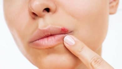 herpes en los labios / herpes labial