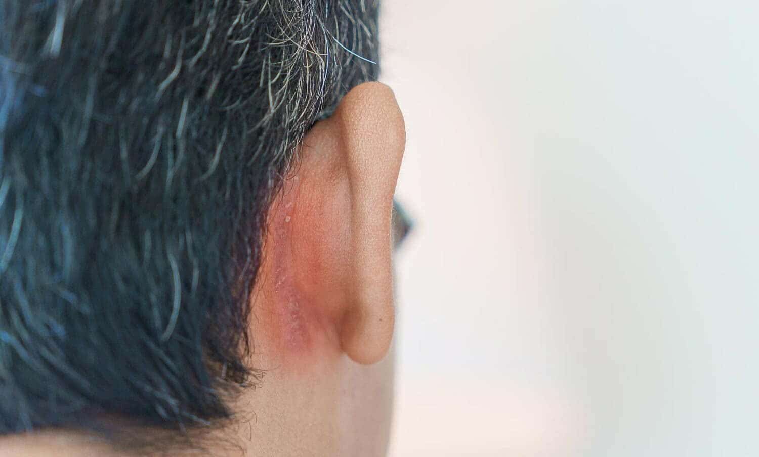 hombre con dermatitis seborreica en la parte de atr&aacute;s de su oreja