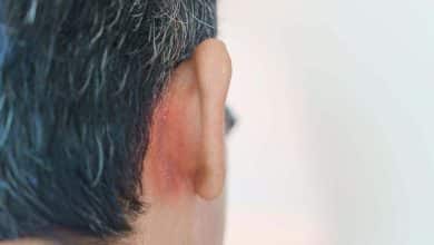 hombre con dermatitis seborreica en la parte de atr&aacute;s de su oreja