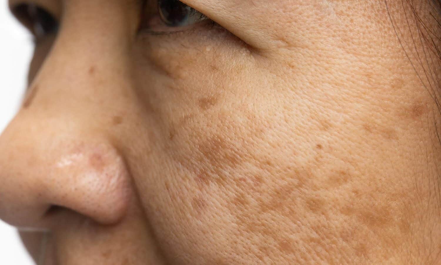 rostro de mujer mayor con hiperpigmentaci&oacute;n en la piel