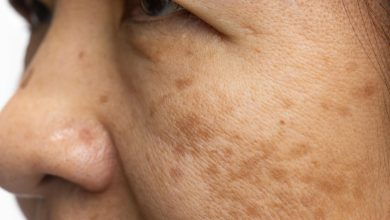 rostro de mujer mayor con hiperpigmentaci&oacute;n en la piel