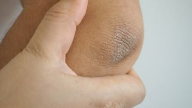 Remedios naturales para aclarar rodillas y codos