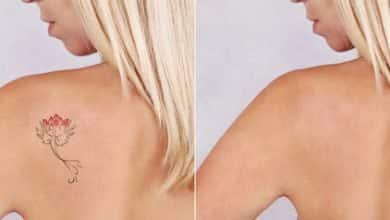 Hermosa joven antes y despu&eacute;s del tratamiento de eliminaci&oacute;n de tatuajes