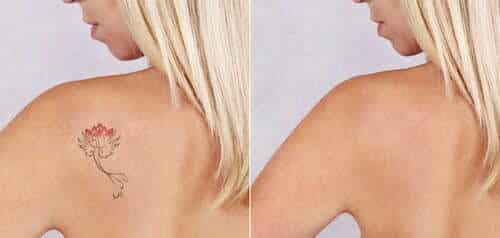 Hermosa joven antes y despu&eacute;s del tratamiento de eliminaci&oacute;n de tatuajes