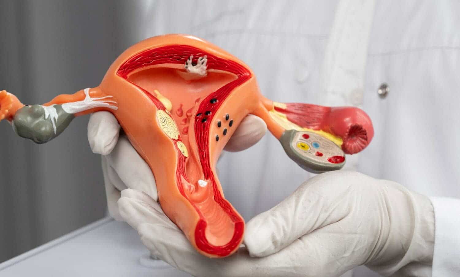 Doctor sosteniendo modelo anat&oacute;mico del sistema reproductor femenino para explicar la endometriosis